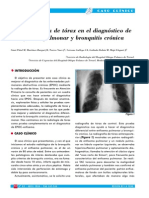 Enficema Pulmonar