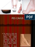 Pes Cavus ....