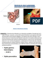 Diverticulo de Meckel