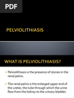 PELVIOLITHIASIS