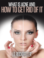 What is Acne and How to Get Rid of It