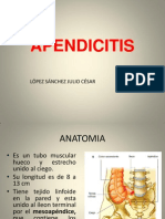 Apendicitis