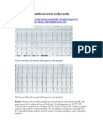 Filed Under: Multifocal Atrial Tachycardia