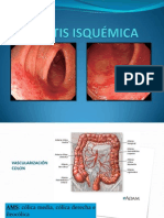 Colitis Isquemica