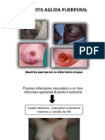 Mastitis Aguda Puerperal