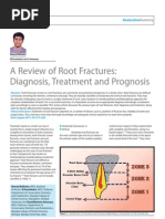 Root Fractures