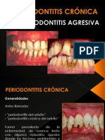 Periodontitis Crónica y Agresiva