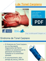 Sindrome de Tunel Carpiano Grados