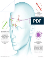 Illustration: Treating Migraines With Surgery