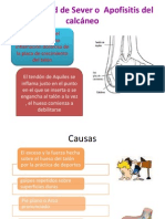 Enfermedad de Sever o Apofisitis Del Calcáneo