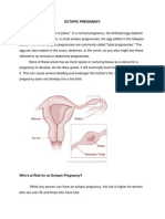 Ectopic Pregnancy