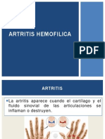 Artritis Hemofilica