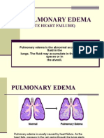 Pulmonary Edema: (Acute Heart Failure)