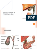 Colestasis - Colelitiasis