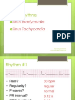 Sinus Brad, Tach, PAC, PVC