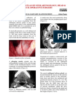 Ranula and Sublingual Salivary Gland Excision