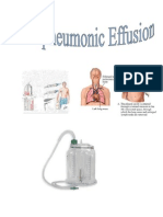 Parapneumonic Effusion - Case Study Adult I