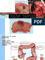 Colon Cancer