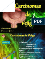 Carcinomas de Vejiga