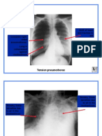 Shift of Heart and Trachea To Left: Tension Pneumothorax