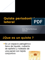 Quiste Periodontal Lateral