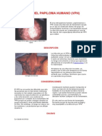 Virus Del Papiloma Humano