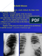 Hydatid Disease: or Iceberg Sign