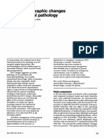 Electrocardiographic Changes and Intracranial Pathology: Geraldine Syverud, Crna, BSN