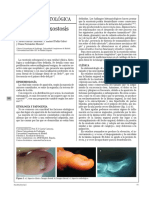 Cirugia de La Exostosis Subungueal