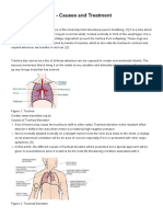 Tracheal Deviation - Causes and Treatment