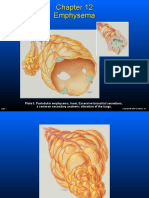 Emphysema 