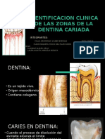 1deagosto Operatoria Dental, Caries en Dentina