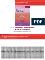 ECG Workout Flashcards: Atrial Arrhythmias