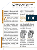 Technique of Reduction and Fixation of Unicondylar Medial Hoffa Fractur