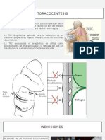 Toracocentesis