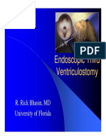 Endoscopic Third Ventriculostomy