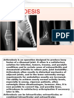 Arthrodesis Visualbee2 140217084354 Phpapp02