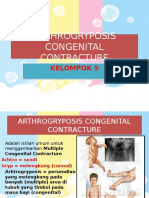 Arthrogryposis Congenital Contracture