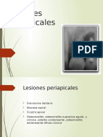 Lesiones Periapicales