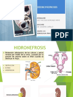 Hidronefrosis Lucy Final