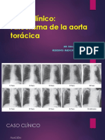 Caso Aneurisma de Aorta Toracica