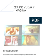 Cancer de Vulva y Vagina