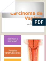 Carcinoma de Vagina