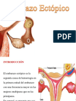 Embarazo Ectopico Presentacion
