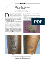 A Novel Visual Clue For The Diagnosis of Hypertrophic Lichen Planus