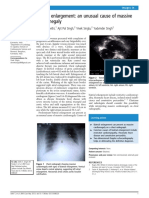 Biatrial Enlargement: An Unusual Cause of Massive Cardiomegaly