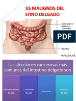 Tumores Malignos Intestino Delgado