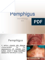 Pemphigus Vulgaris