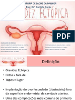 TRABALHO Gravidez Ectópica