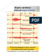 Soplo Cardiaco